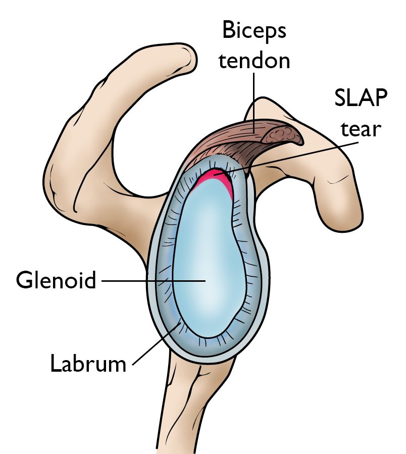 Shoulder Labral Tear